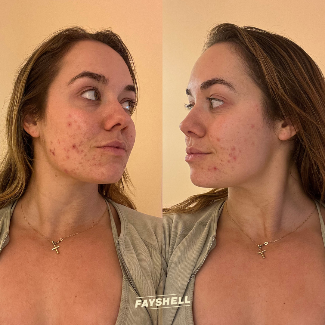 New Client Acne Offer