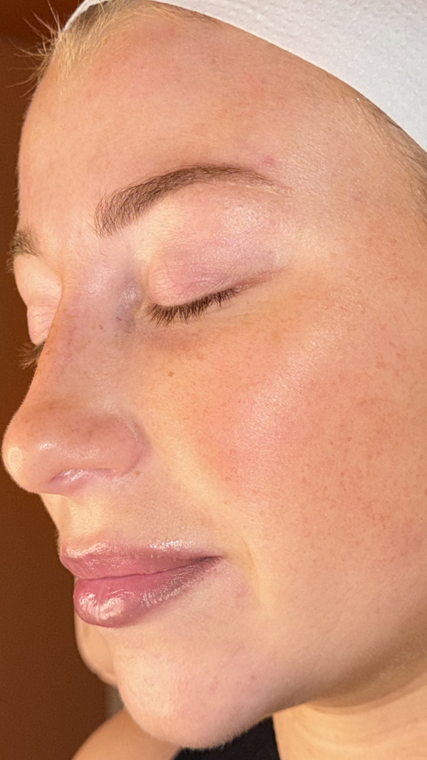 Before treatment - Olivia