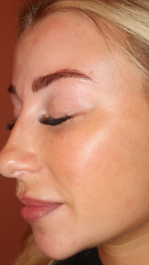 After treatment - Olivia