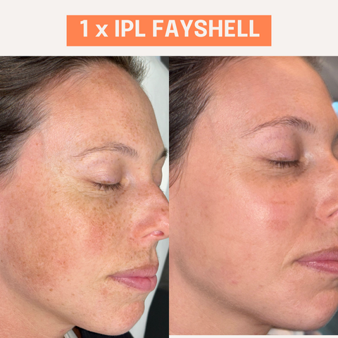 1 x IPL Fayshell Treatment
