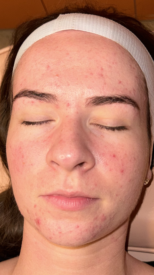 Before treatment - Ellen