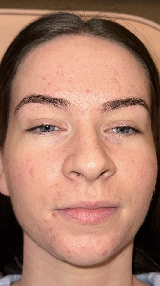 After treatment - Ellen