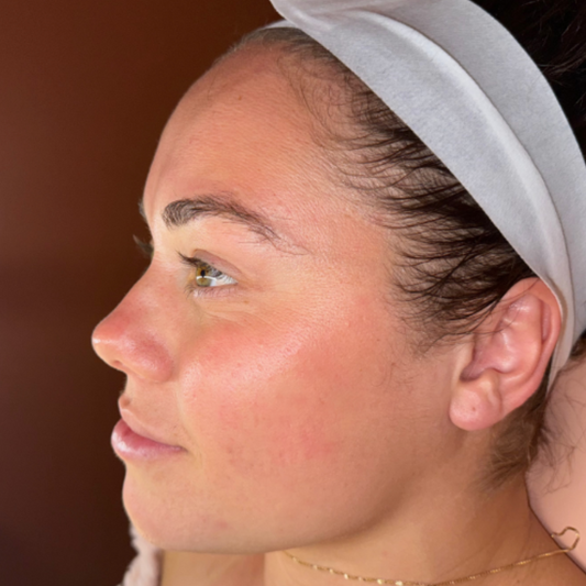 New Client Acne Offer