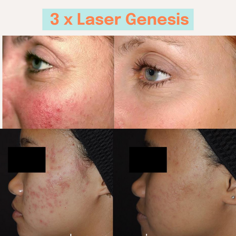 3 x Laser Genesis Treatments