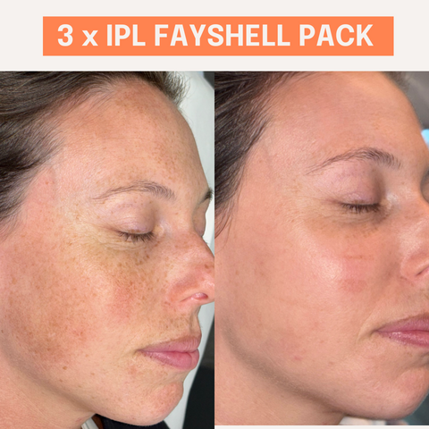 3 x IPL Fayshell Treatments
