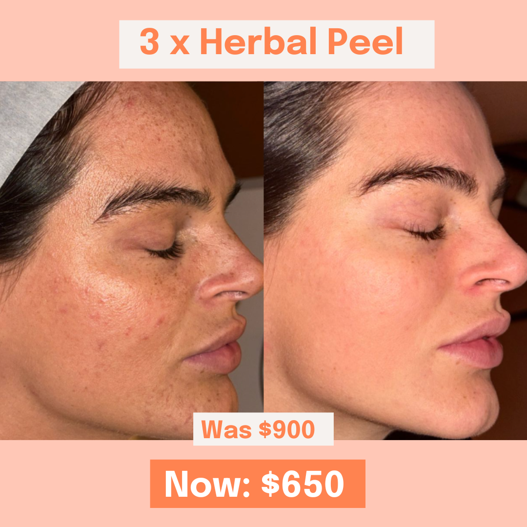 on: my skin HERB PEELING 4ml×8pcs 3 x Herbal B Peel Pack – Fayshell
