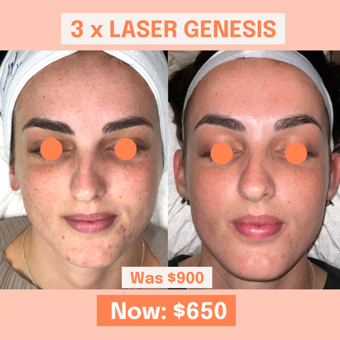 3 x Laser Genesis Pack