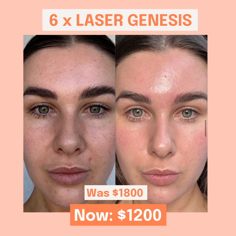 6 x Laser Genesis Pack