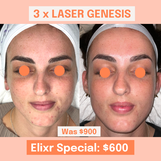 3 x Laser Genesis Pack Elixr Special