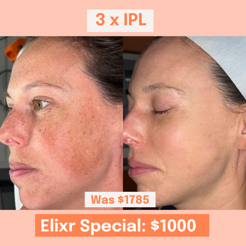 3 x IPL Fayshell Treatments ELIXR SPECIAL