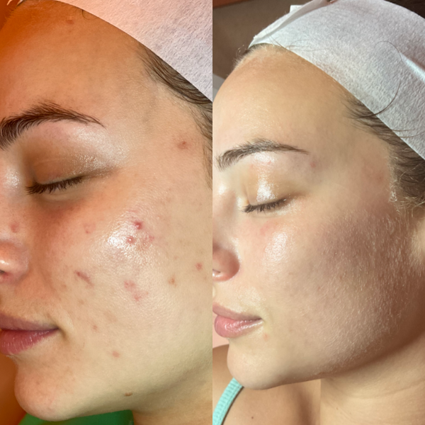 3 x Skin Needling Pack