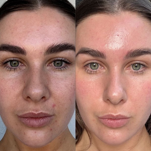 6 x Laser Genesis Pack