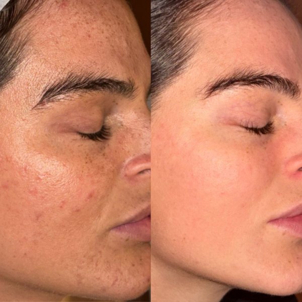 3 x Herbal B Peel Pack