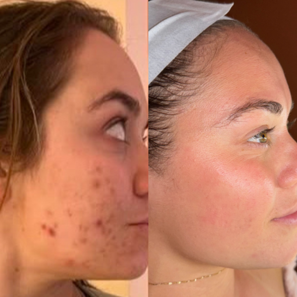 6 x Herbal B Peel Pack