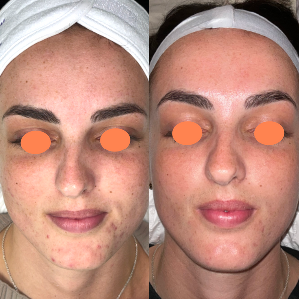 3 x Laser Genesis Pack