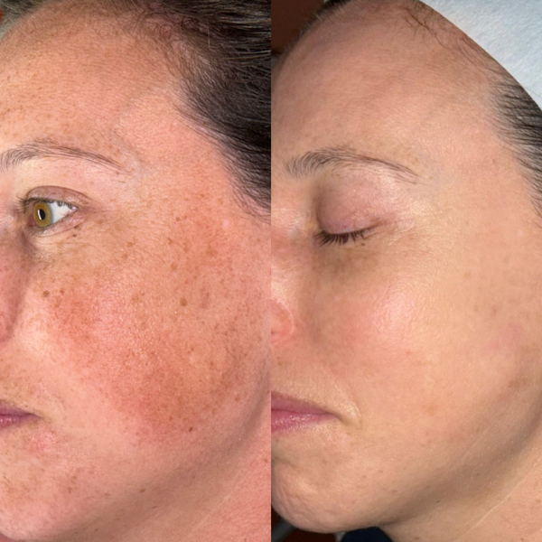 3 x IPL Fayshell Treatments